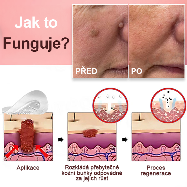 KUBOZN® Náplasti na odstranění kožních výrůstků s nano-mikrojehličkami 🔸🔸