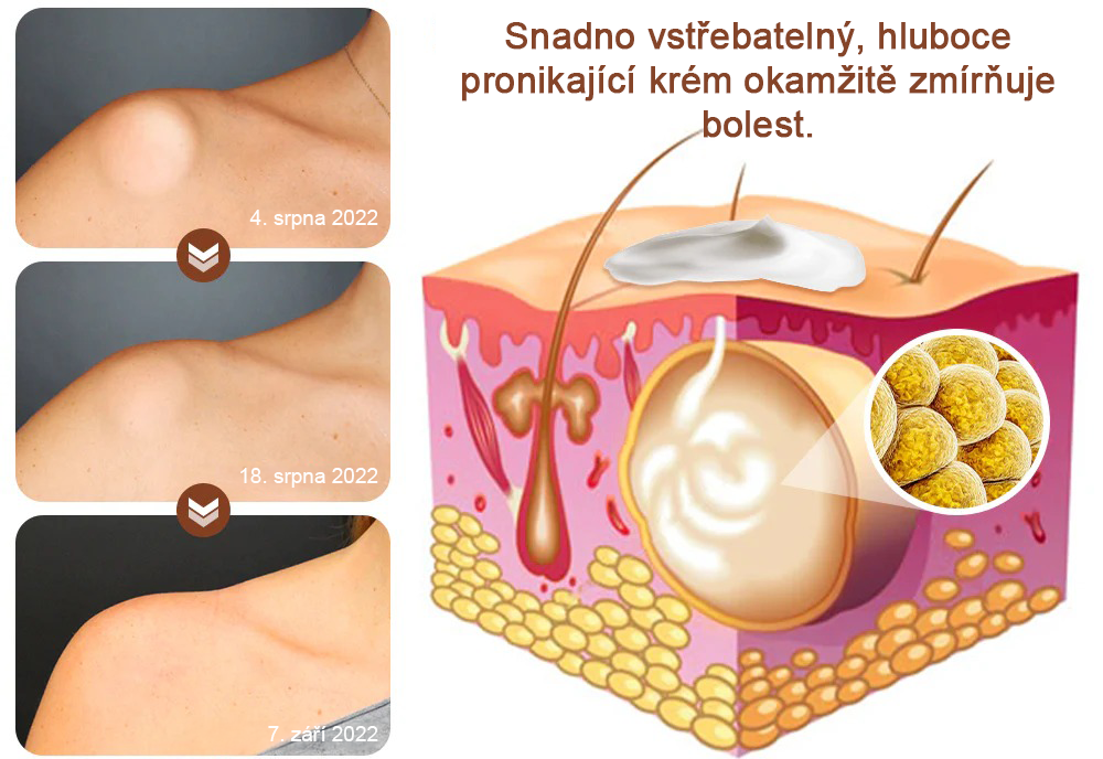 Cvreoz® LipomaCure — Účinná péče o lipomy bez operace