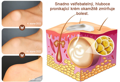 Cvreoz® LipomaCure — Účinná péče o lipomy bez operace