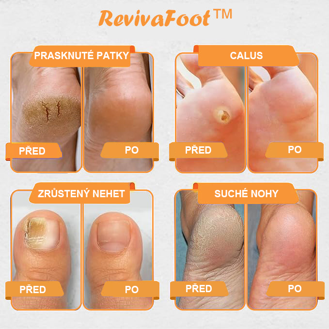 ⏰ RevivaFoot™ Mélthin lymfatické odvodňovací a zeštíhlující šumivé koule do koupele na nohy, snižují otoky až o 70 %【Podpora lymfatického oběhu – řešení problému od samotné příčiny】⏰